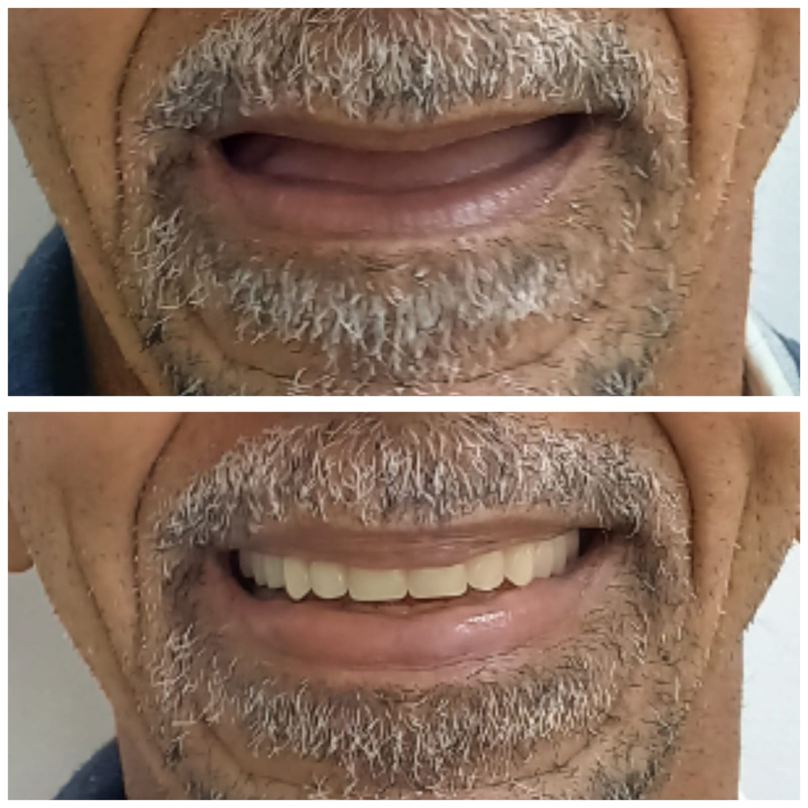 Antes e depois de reabilitação com prótese em paciente atendido na clínica